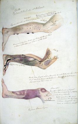 Page from the journal of Henry Walsh Mahon showing the effects of scurvy, from his time aboard HM Convict Ship Barrosa.